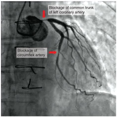What Is A Coronary Angiogram Indications Procedure Risks