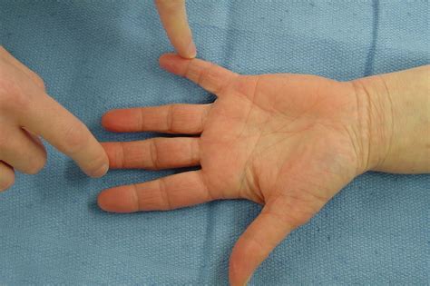 ULNAR ENTRAPMENT GUYON S Hand Surgery Resource