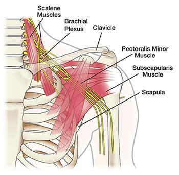 Deltoid trigger points can be aching or deep and throbbing. Shoulder, Arm Pain Treatment Doctors (Top Pain Specialists ...