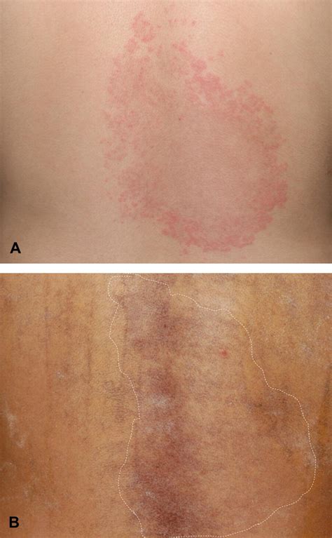 Erythema Papulatum Centrifugum A Sweat Related Dermatitis Journal Of