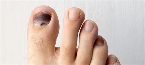 Black Toenails Causes Prevention Tips And How To Treat