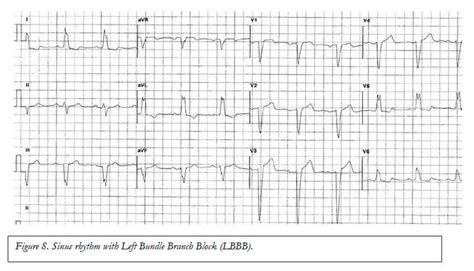 Normal Ecg Reading