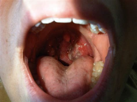 The Gallery For Normal Tonsils Vs Swollen Tonsils