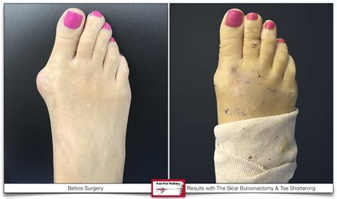 Toe Shortening — Foot First Podiatry Centers