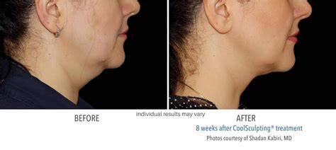 Coolsculpting Chin Fat Coolsculpting Double Chin