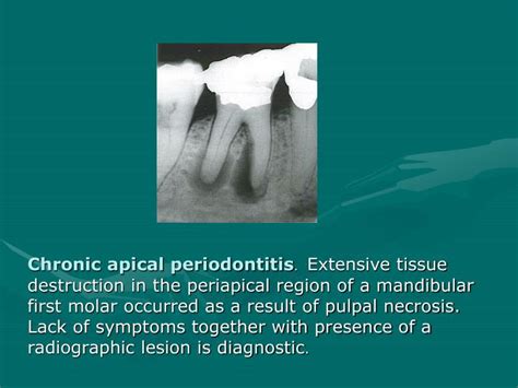 Ppt Periapical Disease Powerpoint Presentation Id5428589
