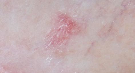 It is a stage 0 melanoma (in situ) because it hasn't grown deeper than the top layer of skin. Amelanotic Melanoma 8-Occult melanoma: = Metastatic ...