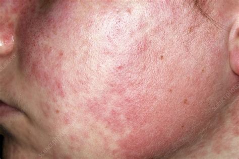 Amoxicillin Rash Face