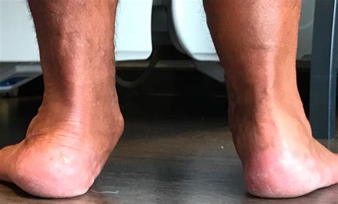 Adult Flat Foot Reconstruction | Minimally Invasive | David Redern
