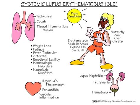 Systemic Lupus Erythematosus Sle Diagram Quizlet