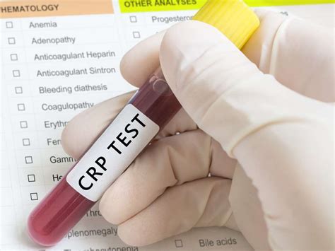 The standard test measures high levels of the protein to find different diseases that cause inflammation. C-reactive protein (CRP) test: High levels, low levels ...