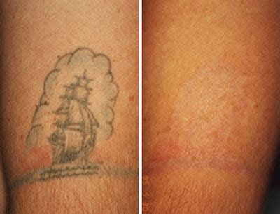Tattoo removal is a procedure done to try to remove an unwanted tattoo. Removing Amateur Tattoos | North Houston Laser Tattoo Removal