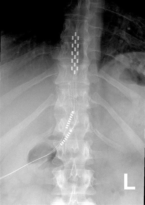 Spinal cord stimulators reduce opioid use — pain news network
