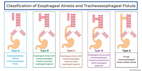 Esophageal Atresia With Distal Tracheoesophageal Fistul Open I Gambaran