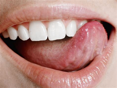 Small Big Sore Red Spots On Tongue Cause Meaning American Celiac