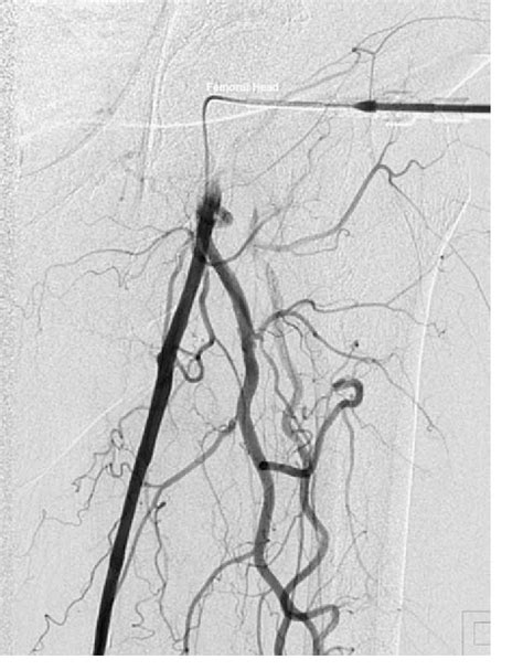 Nitial Antegrade Angiogram From Left Common Femoral Artery Puncture