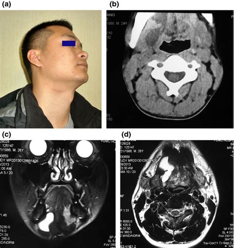 Correct Diagnosis For Plunging Ranula By Magnetic Resonance Imaging