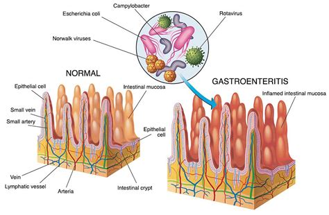Gastroenteritis Lookcrown