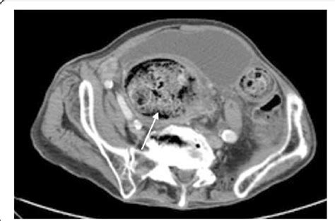 Ct Scan Image Of The Abdomen Showing Large Amount Of Retained Stool In