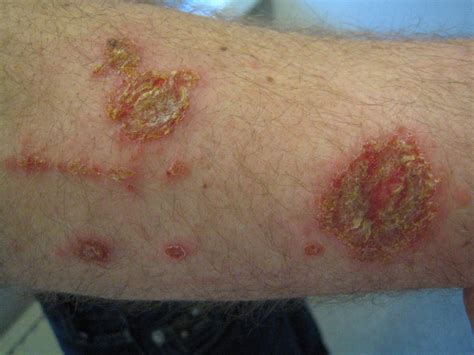 Stafylokokken Infecties Huidarts Com