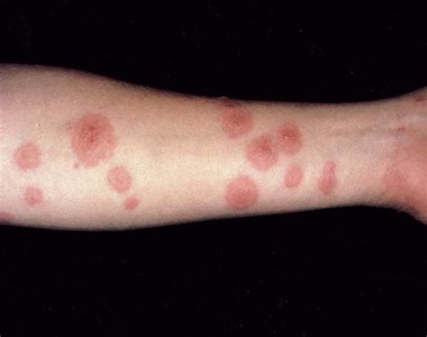 Erythema Multiforme Pediatric Diseases And Conditions 5minuteconsult