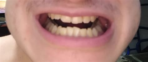 Minor issues can be solved with a removable retainer. Are braces gonna fix this overbite? : braces