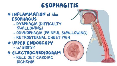 Esophagitis Clinical Video Anatomy Definition Osmosis