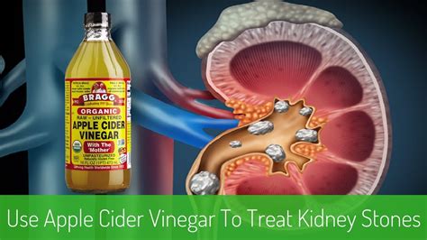 Get Rid Of Kidney Stones With Apple Cider Vinegar Kidney Stone