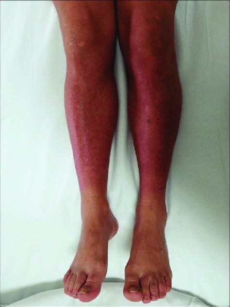 Papular Purpuric Lesions And Occasional Petechiae Of The Legs