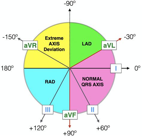 S greater than r in lead i = right axis s greater than r in lead ii = left axis 3) p wave =atria depolarising should be 1 p for every qrs: ECG Axis Interpretation • LITFL • ECG Library Basics