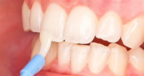 Restoration Of Tooth Enamel Siy Dental