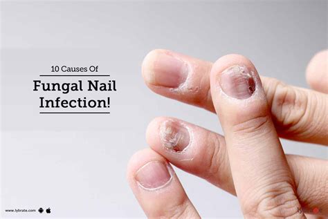 10 Causes Of Fungal Nail Infection By Dr Saurabh Sharma Lybrate