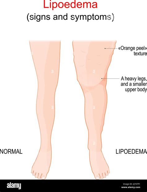 Lipoedema Or Lipedema Abnormal Build Up Of Fat In Legs Difference And