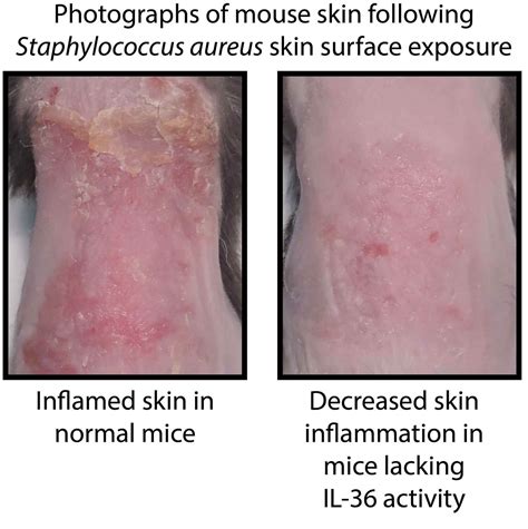 How The Skin Becomes Inflamed 11082017
