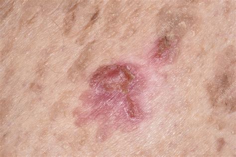 Inflamed Seborrheic Keratoses Stock Image C0498699 Science Photo