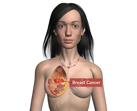 Breast Cancer Treatment Prevention Symptoms Stages Signs