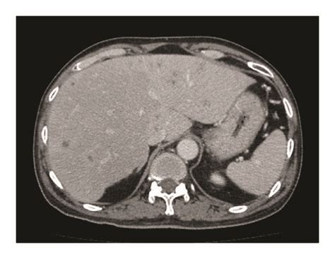 Axial Computed Tomography Ct Scan Portal Venous Phase Shows