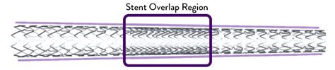 Xience Skypoint Stent 48 Mm For Long Lesions Abbott
