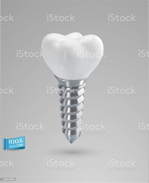 Ilustración De Implante Dental Realista Vectorial Aislado Sobre Fondo