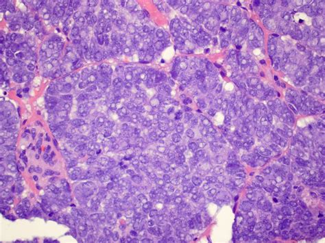 It's not clear what causes merkel cell carcinoma. Merkel Cell Carcinoma | H&E, 40x Contributed by Juan A ...