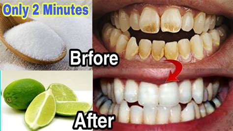 Get Whiten Teeth At Home In 2 Minutes Easy And Quic How To Get White