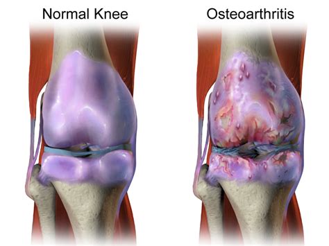 The 4 stages of rheumatoid arthritis progression. Difference Between Osteoarthritis and Rheumatoid Arthritis ...