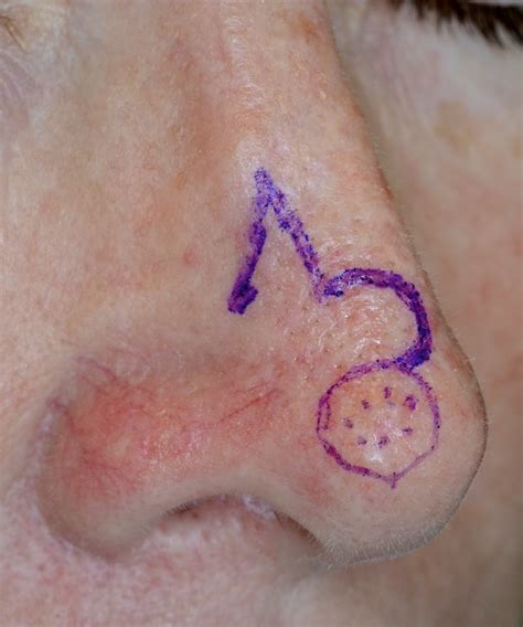 We did not find results for: Skin Cancer On Nose Early Stages - Idaman