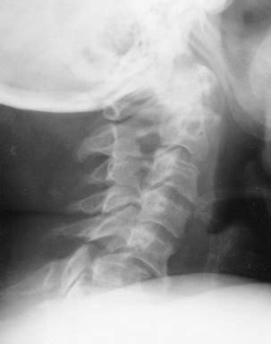 Management Of Traumatic Unilateral Jumped Cervical Facet Joint Without