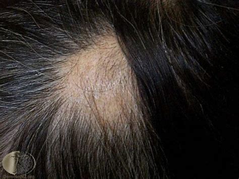 Alopecia Areata Oslo Hudlegesenter
