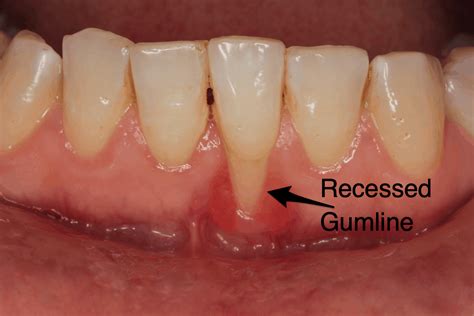 What Is Gum Recession In Dentistry Archwired