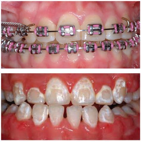 How To Reduce White Spots During Orthodontic Treatment Dental News
