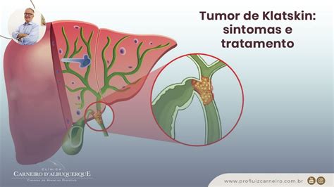Tumor De Klatskin Sintomas E Tratamento Prof Dr Luiz Carneiro Crm
