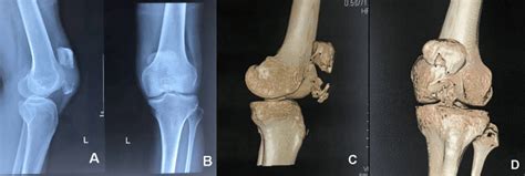 Pathologic Fracture Of The Patella Secondary To A Gouty Tophus