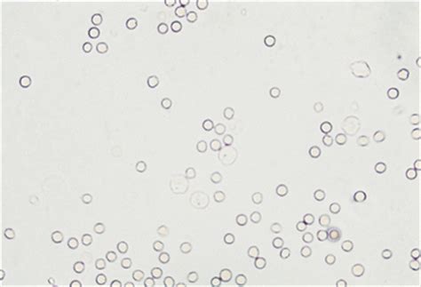 Figure 1 urine sediment enlarged ten times shows abundant epithelial cells. Examination of the Urinary Sediment | Veterian Key